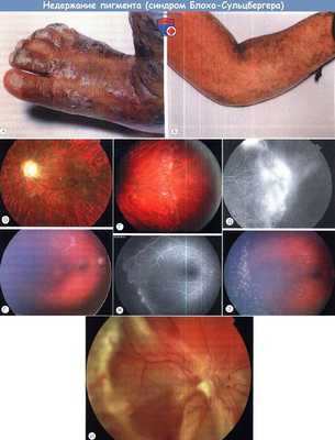 Недержание пигмента - синдром Блоха Сульцбергера