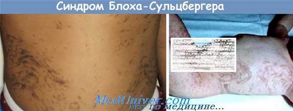 Синдром Блоха-Сульцбергера