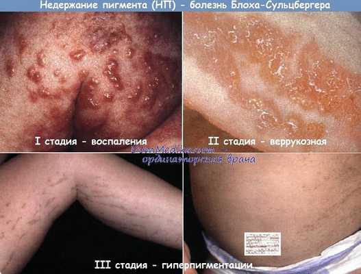 недержание пигмента - синдром Блоха-Сульцбергера