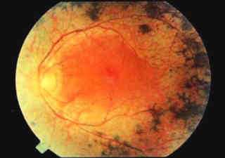 Пигментный ретинит