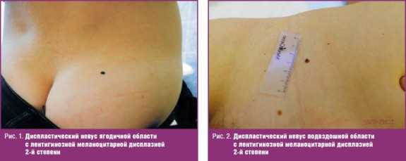 Диспластический невус ягодичной области
