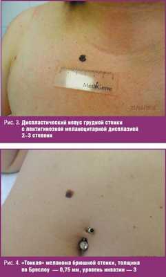 Диспластический невус грудной стенки
