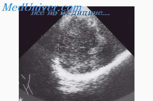 пионефроз на узи