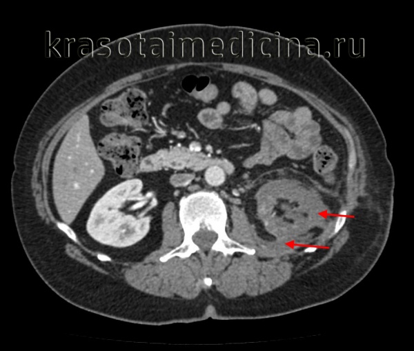 Анальгетическая нефропатия