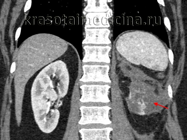 КТ ОБП/ЗП. Гнойное расплавление левой почки (этот же пациент).