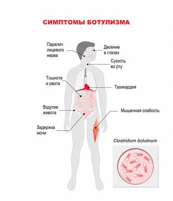 Симптомы ботулизма.jpg