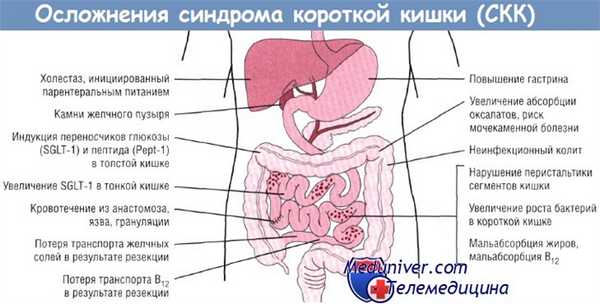 Осложнения синдрома короткой кишки (СКК)