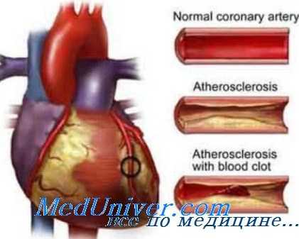 коронарная недостаточность