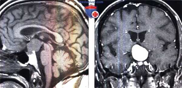 Питуицитома на МРТ головного мозга