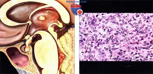 Питуицитома на макропрепарате головного мозга