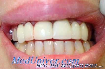 протезирование мостовидным протезом