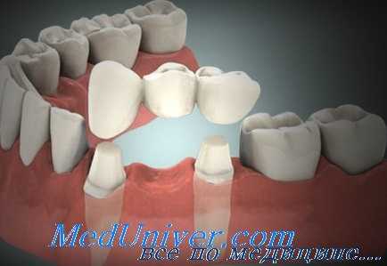 конструкции мостовидного протеза