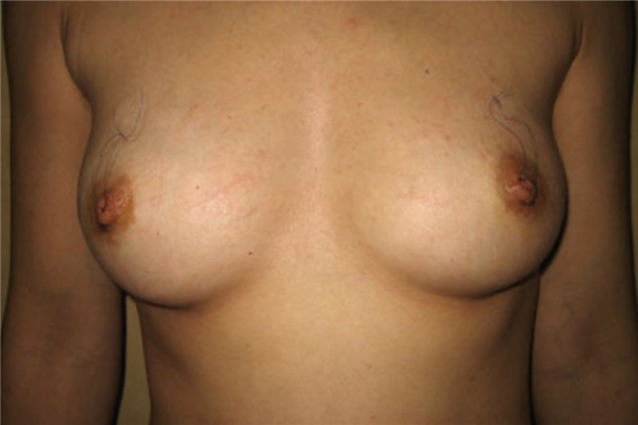 втянутые соски