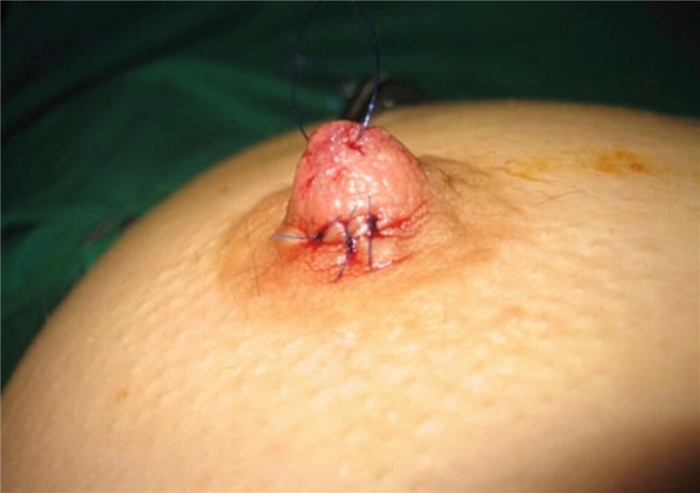 втянутые соски