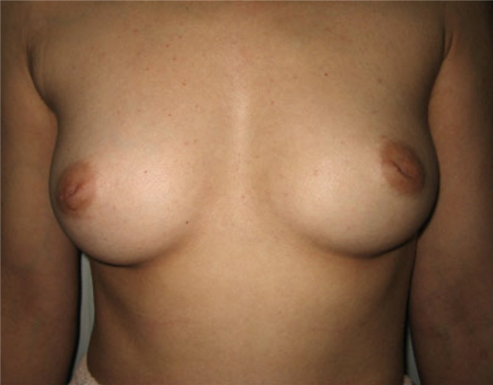 втянутые соски