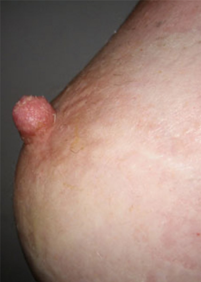 втянутые соски