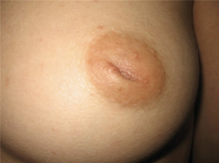 втянутые соски