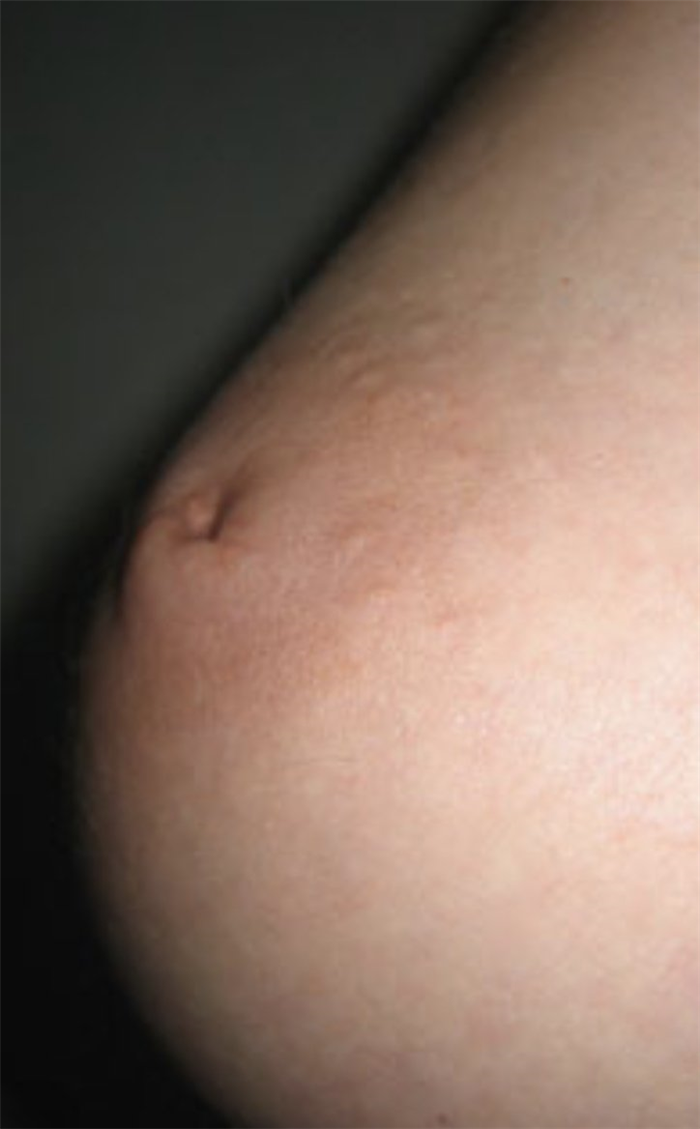 втянутые соски