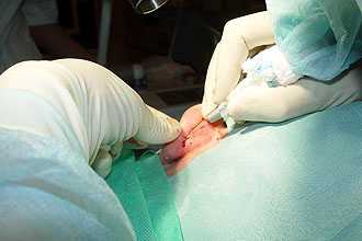 Лазерная отопластика