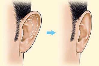 Отопластика ушей