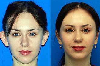 Виды отопластики