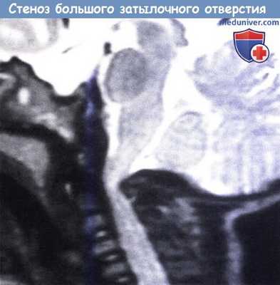 Стеноз большого затылочного отверстия