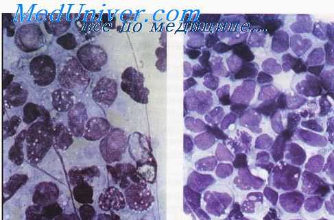 обменное переливание