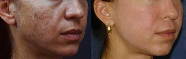 До и после плазмотерапии