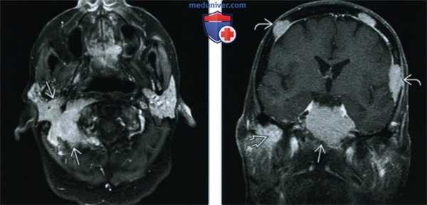 Миеломная болезнь основания черепа - лучевая диагностика