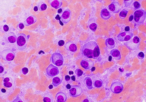 Клетки плазмоцитомы под микроскопом