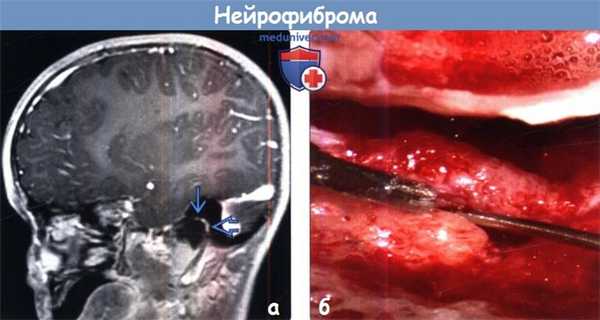 Нейрофиброма на МРТ