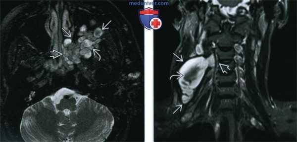 Плексиформная нейрофиброма головы и шеи - лучевая диагностика
