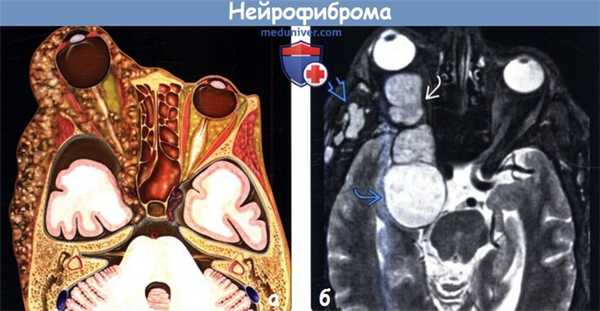 Нейрофиброма на МРТ