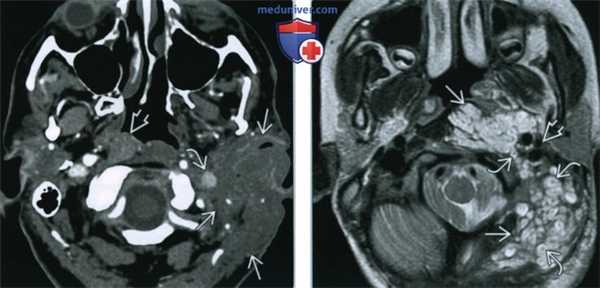 Плексиформная нейрофиброма головы и шеи - лучевая диагностика