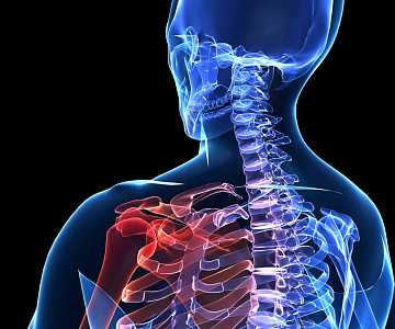 Фото Плексит плечевого сустава