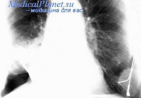 резекция легких