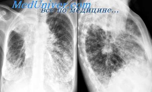 плевральная пластика