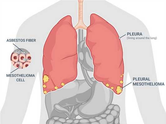Канцероматоз плевры