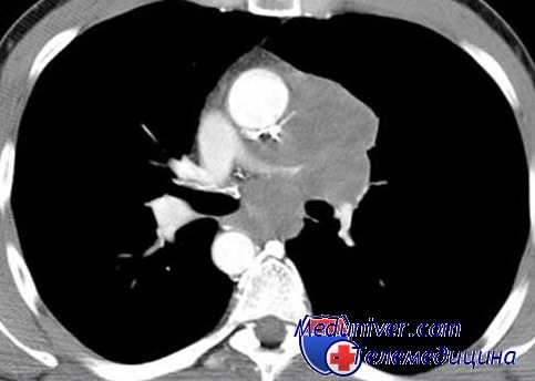 экстраплевральная полость