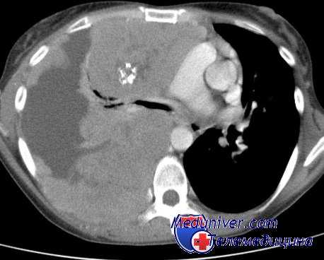 парафин в медицине