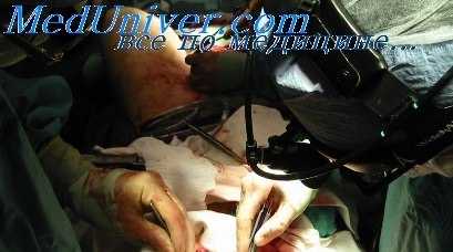 техника пневмолиза