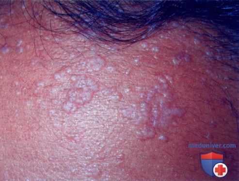 Плоские бородавки