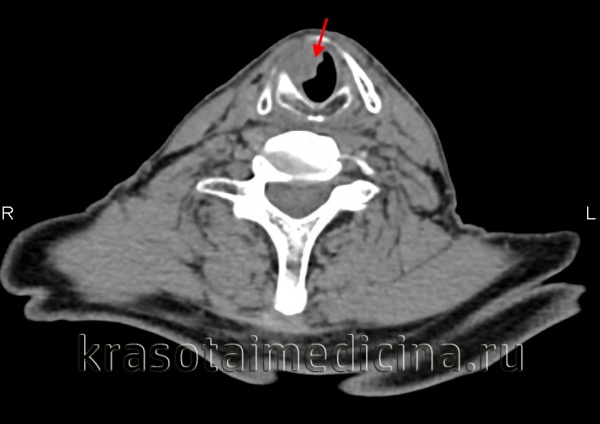 Рак гортани