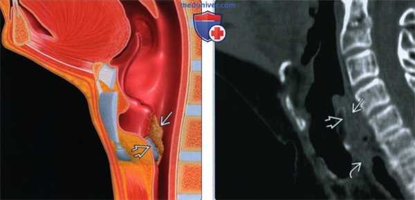 Плоскоклеточный рак за перстневидной области - лучевая диагностика