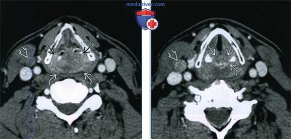 Плоскоклеточный рак за перстневидной области - лучевая диагностика