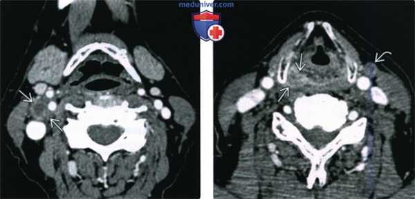 КТ, МРТ при плоскоклеточном раке грушевидного синуса