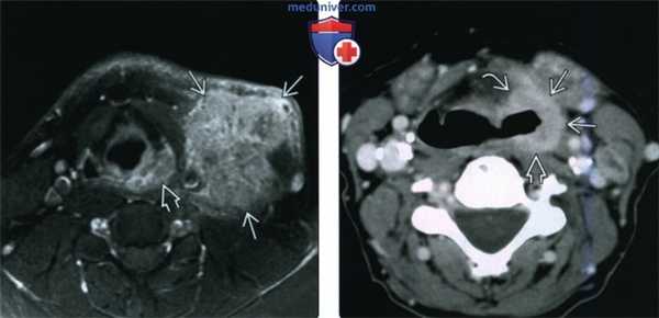 КТ, МРТ при плоскоклеточном раке грушевидного синуса