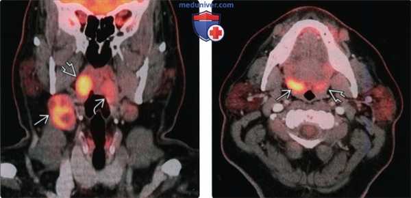 КТ, МРТ при плоскоклеточном раке небной миндалины