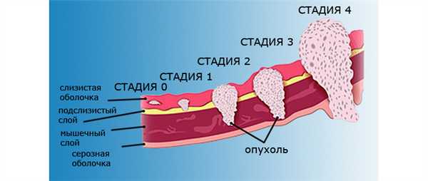 Стадии развития опухоли