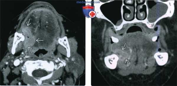 КТ, МРТ при плоскоклеточном раке тела и верхушки языка